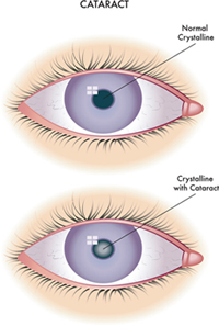 Cataract Surgery