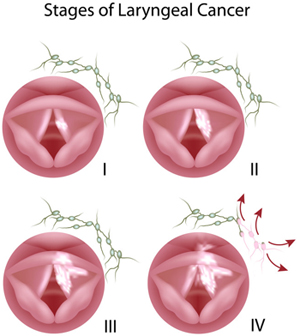 Laryngeal Cancer