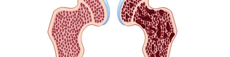 brittle bone disease 1