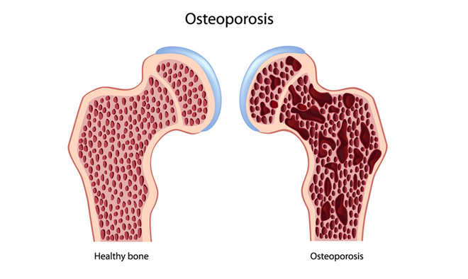 Brittle Bone Disease