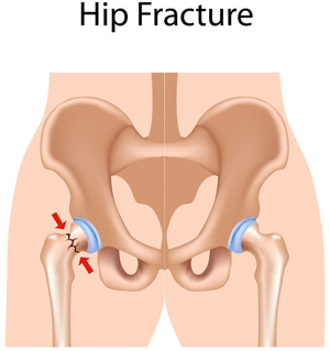 Hip Fractures